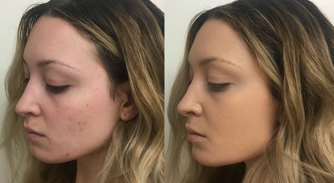 acné-cicatrice-couverture-fonds-de-fond-too-face-peach-perfect