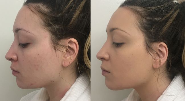 Acné-Cicatrices-Couverture-Fondations-ysl-touche-eclat