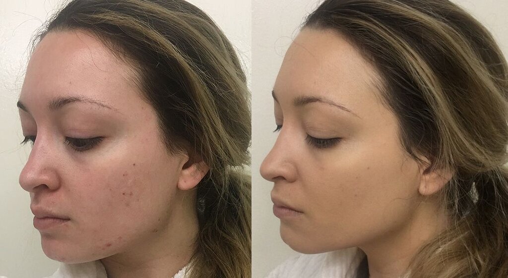 Les 3 seuls fonds de teint qui couvrent mes cicatrices d’acné kystique, mais qui ont toujours l’air naturel Les 3 seuls fonds de teint qui couvrent mes cicatrices d’acné kystique, mais qui ont toujours l’air naturel