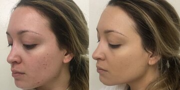 Les 3 seuls fonds de teint qui couvrent mes cicatrices d’acné kystique, mais qui ont toujours l’air naturel