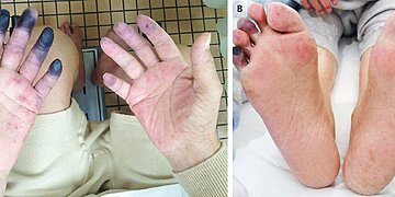 Doigts noircis : comment cela se produit-il ?