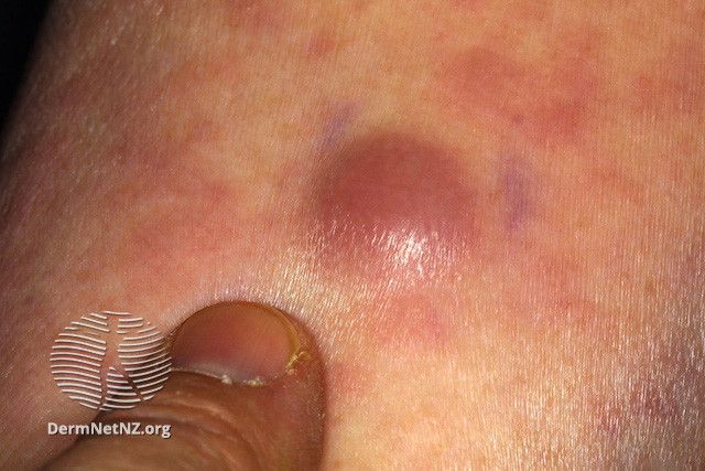 Éruptions cutanées leucémiques : pourquoi ces lésions cutanées se produisent et à quoi elles ressemblent