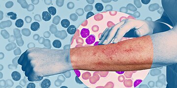 Éruptions cutanées leucémiques : pourquoi ces lésions cutanées se produisent et à quoi elles ressemblent