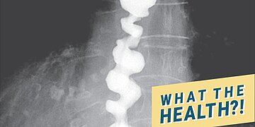 Qu’est-ce que l’œsophage en tire-bouchon ? Voici ce que dit un gastro-entérologue