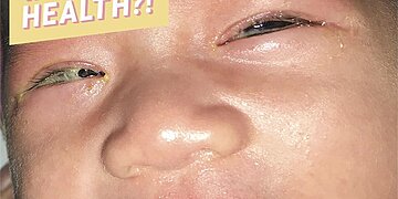 Un bébé a attrapé la chlamydia de sa mère – dans ses yeux