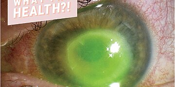 Nager dans des lentilles de contact peut entraîner une perte de vision : voici comment