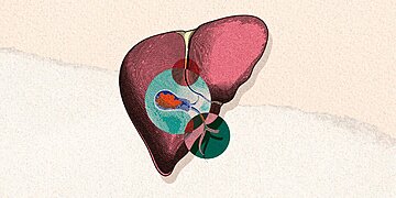 Qu’est-ce que la cholécystite aiguë ? Comment savoir si votre vésicule biliaire est enflammée et que faire à ce sujet
