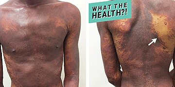 Qu’est-ce que l’éruption cutanée liée au VIH ?