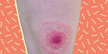 À quoi ressemble une piqûre de tique ?