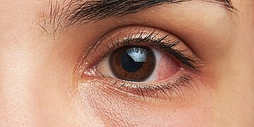 5 Symptômes des yeux roses à surveiller