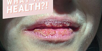 Les excroissances sur les lèvres de cette femme étaient en fait un signe rare qu’elle est à risque de cancer du sein