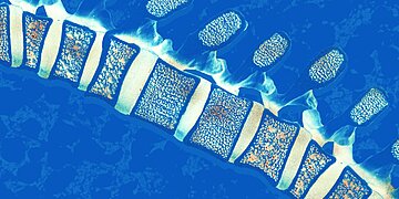 Qu’est-ce que le myélome multiple ? Les médecins expliquent ce cancer des cellules plasmatiques