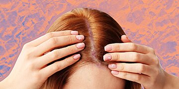 Que faire contre le psoriasis en plaques sur votre cuir chevelu : traitements recommandés par les dermatologues