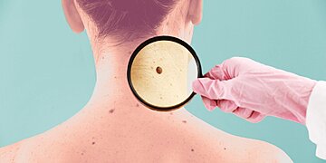 Grains de beauté cancéreux : symptômes et causes du mélanome