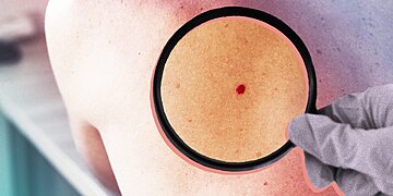 Qu’est-ce qu’un angiome cerise ?