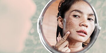 Qu’est-ce que le mélasma ? Les dermatologues expliquent comment traiter ces taches sombres sur votre visage