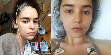 Emilia Clarke Game of Thrones Star avait 2 anévrismes cérébraux – Voici les symptômes et les risques héréditaires à surveiller