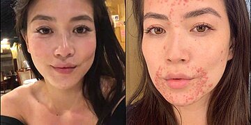 L’ancre de CBS, Frances Wang, révèle un état de peau douloureux dans une publication émotionnelle sur Instagram