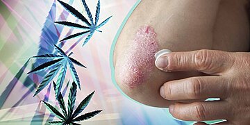 Le CBD peut-il soulager les symptômes du psoriasis ? Voici ce que disent les médecins