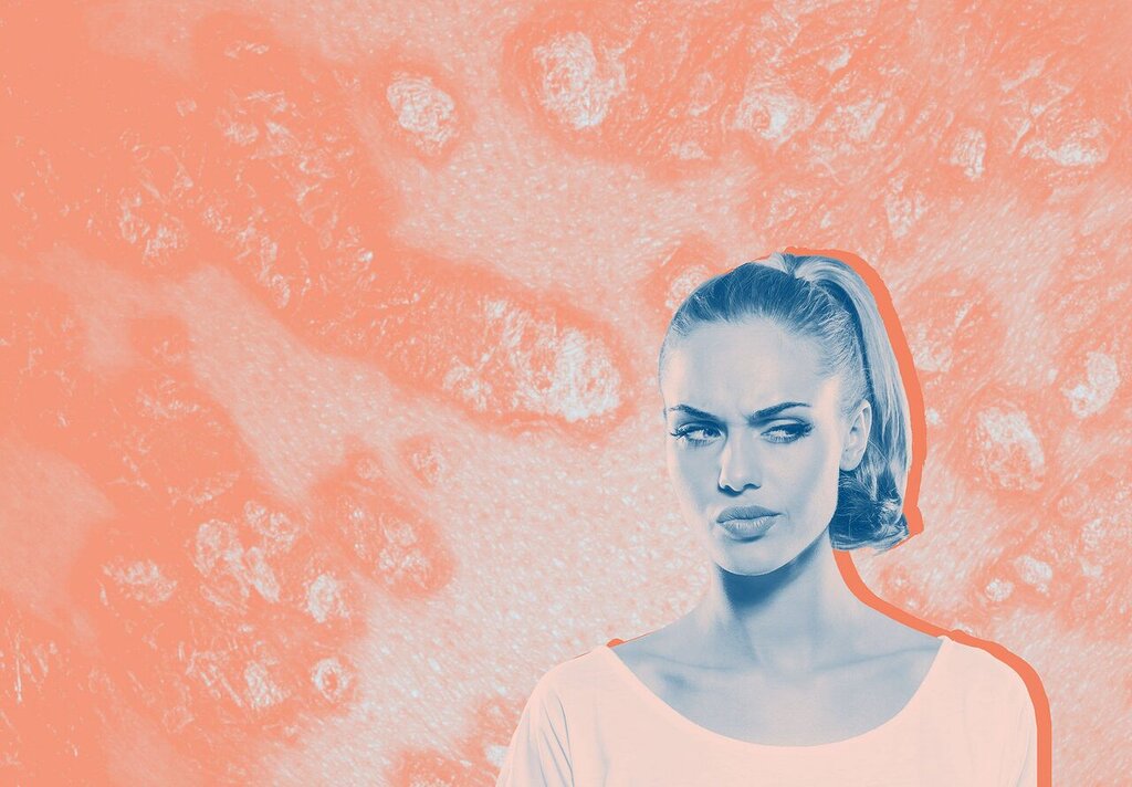 Le psoriasis est-il contagieux ? Ce que les dermatologues ont à dire Le psoriasis est-il contagieux ? Ce que les dermatologues ont à dire