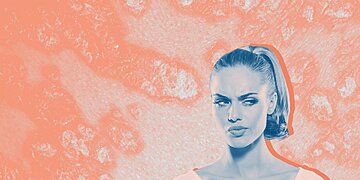 Le psoriasis est-il contagieux ? Ce que les dermatologues ont à dire