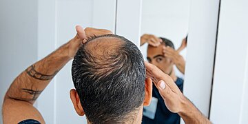 Minoxidil oral pour la perte de cheveux : ce qu’il faut savoir sur l’utilisation hors AMM du médicament