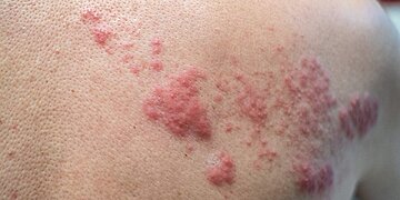 Qu’est-ce qui cause réellement le zona et comment vous pouvez le prévenir