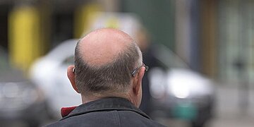 La calvitie : un sucre naturel peut-il ralentir la chute des cheveux ? Cette étude propose des solutions.