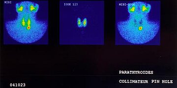 Recommandations actualisées pour traiter l’hyperparathyroïdie primaire