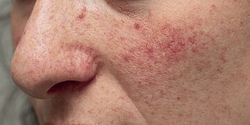 Rougeurs faciales : quelles solutions pour atténuer et traiter la couperose ?