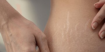 Comment éliminer efficacement les vergetures ?