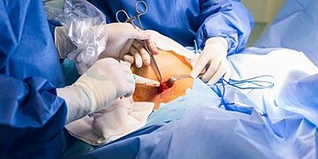 Chirurgie nécessaire pour un carcinome canalaire de bas grade ?