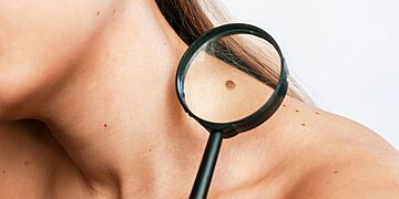 Symptômes cutanés du cancer de la peau à surveiller selon un spécialiste