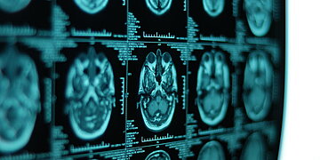 Pourquoi résiste-t-il souvent à l’immunothérapie ?