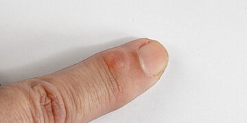 Kyste mucoïde : symptômes, diagnostic et options de traitement à explorer
