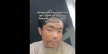 Un utilisateur de TikTok a été défiguré par un molluscum après avoir porté des vêtements d’occasion sales